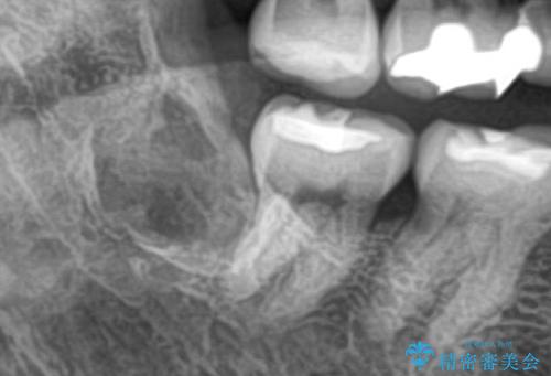 親知らず抜きたい。の治療後