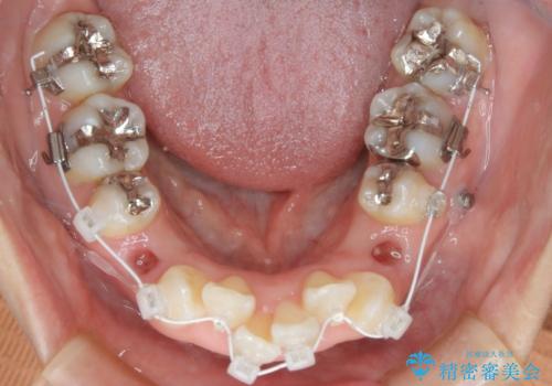 出っ歯が気になる　抜歯+ワイヤー矯正治療の治療中