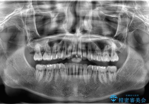 デコボコも深いかみ合わせも…“全部気になる”を一気に解決の治療後