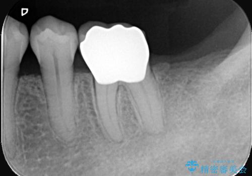 繰り返すプラスチックの欠けを解消。広範囲の修復に適したセラミッククラウンの治療後