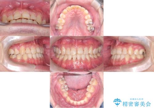 【ワイヤー矯正】かみ合わせを治したいの治療後