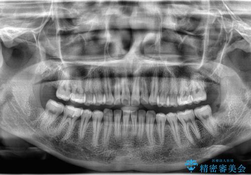 親知らず抜歯の治療後