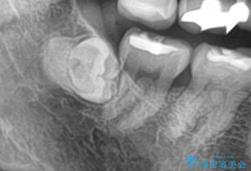 親知らず抜きたい。