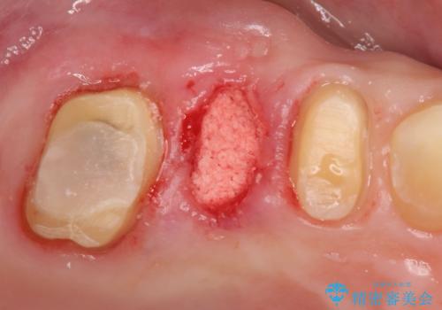 過大な力で折れた失活歯 セラミックブリッジ治療の治療中