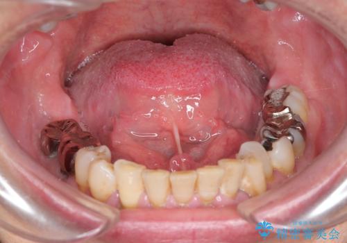 『舌小帯形成術』 ベロの動きを良くして滑舌を改善したい