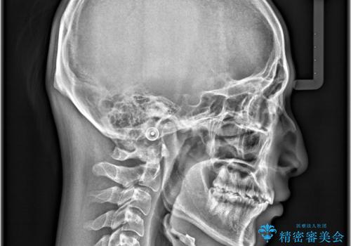 デコボコも深いかみ合わせも…“全部気になる”を一気に解決の治療後