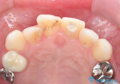 転んで折れた前歯セラミック治療で審美改善の治療中