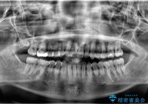 「歯を抜かずに、たった10ヵ月。」目立ちにくい大人の矯正の治療前