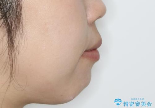 出っ歯が気になる　抜歯+ワイヤー矯正治療の治療後