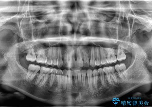 1年でここまで変わる。デコボコ歯並びの非抜歯矯正!の治療後