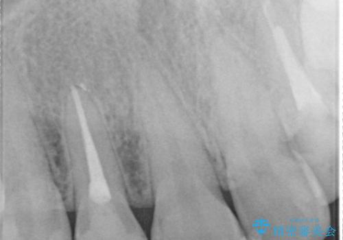 歯に食べ物がはさまる　色も揃えたい　オールセラミックで治療の治療前