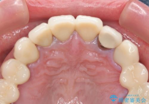 保険適応 硬質レジン前装冠から審美的でオールセラミッククラウンへの治療後