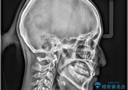 1年でここまで変わる。デコボコ歯並びの非抜歯矯正!の治療前
