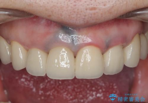 保険適応 硬質レジン前装冠から審美的でオールセラミッククラウンへの治療後