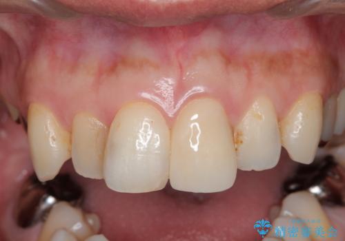 転んで折れた前歯セラミック治療で審美改善の治療後