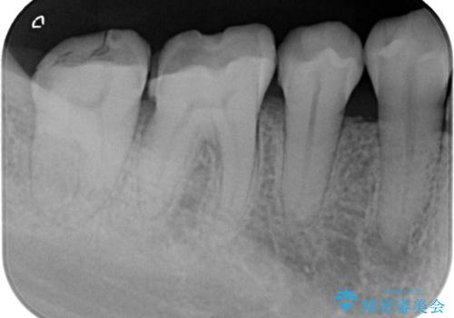 欠けやすい大きなプラスチック充填から、耐久性の高いセラミッククラウンへの治療前