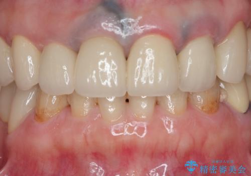 保険適応 硬質レジン前装冠から審美的でオールセラミッククラウンへの治療後