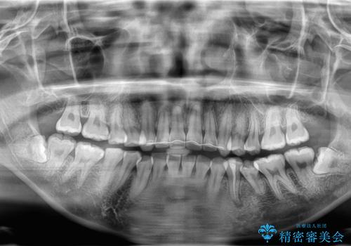 親知らず抜歯の治療前
