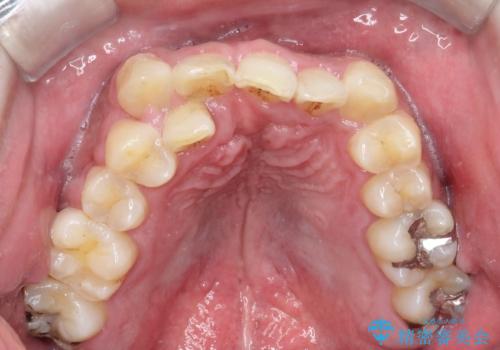 【ワイヤー矯正】かみ合わせを治したいの治療前