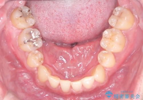 【ワイヤー矯正】かみ合わせを治したいの治療後