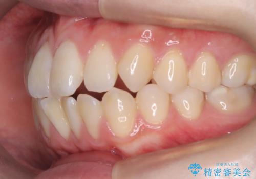 【ワイヤー矯正】前歯の突出感、下の歯の並びを良くしたいの治療前