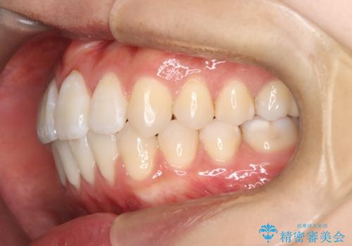 【ワイヤー矯正】前歯の突出感、下の歯の並びを良くしたいの治療後