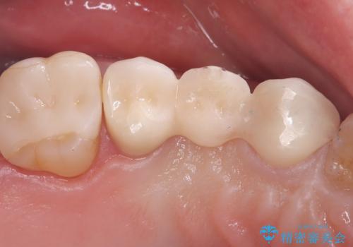 【セラミッククラウン】歯が欠けた!の治療後