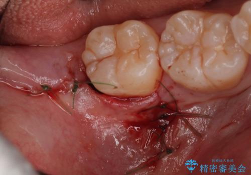 親知らず抜歯の治療後