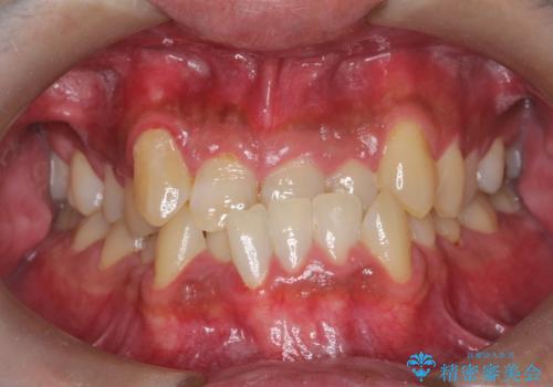 【ワイヤー矯正】かみ合わせを治したい