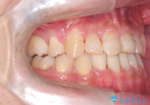 【ワイヤー矯正】かみ合わせを治したいの治療後