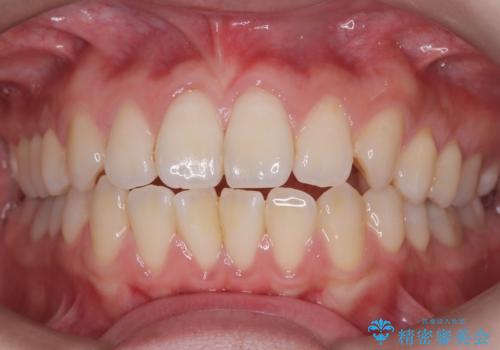 【ワイヤー矯正】前歯の突出感、下の歯の並びを良くしたいの治療前