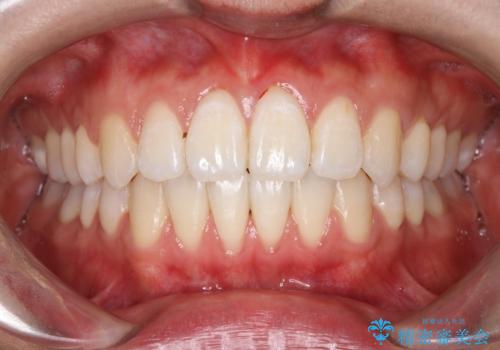 【ワイヤー矯正】前歯の突出感、下の歯の並びを良くしたいの治療後