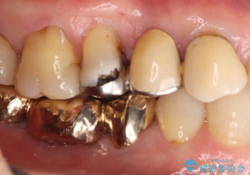 【セラミッククラウン】歯が欠けた!の治療前