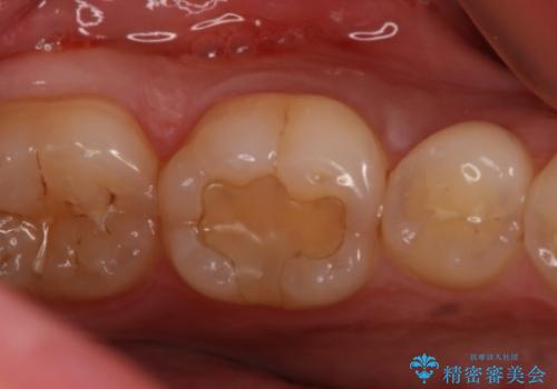 奥歯にセラミックを入れたい　セラミックインレーの治療前