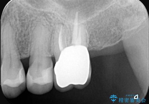根の病変を精密治療で改善。再発を防ぐ根管治療とオールセラミッククラウンの治療後