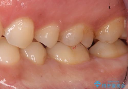 奥歯にセラミックを入れたい セラミックインレーの治療後