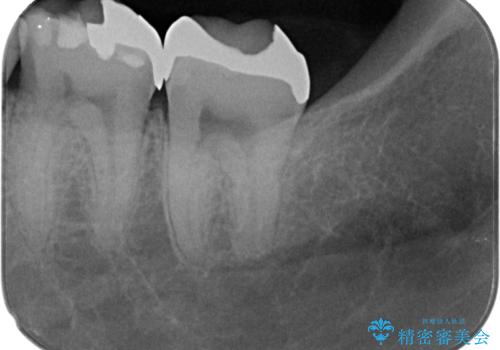 銀歯を白くしたい　セラミックインレー修復の治療前