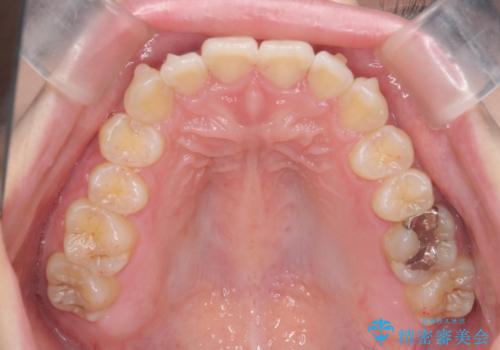 [ インビザラインライト ]  短期間で行う前歯のマウスピース治療の治療中