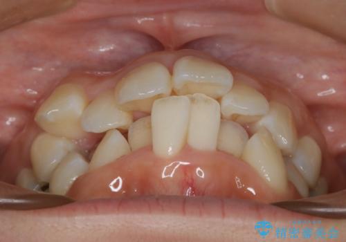 出っ歯が気になる 抜歯+ワイヤー矯正治療の治療前