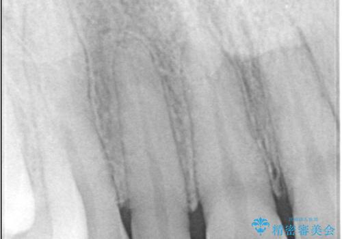 矯正後、矮小歯をオールセラミッククラウンで審美修復の治療前