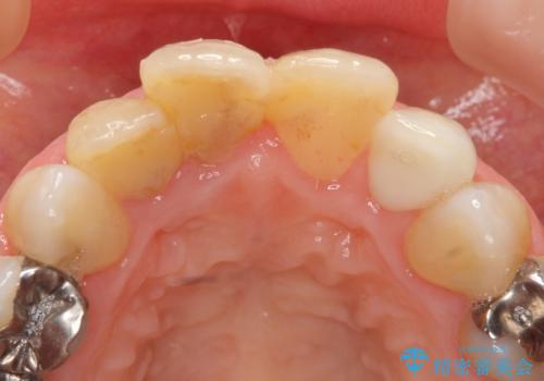[ ジルコニアセラミッククラウン] 神経の死んだ前歯の治療の治療後