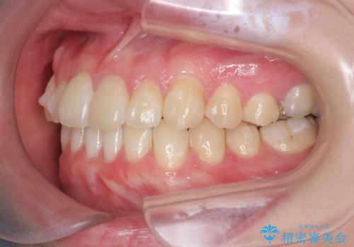 [ インビザラインライト ]  短期間で行う前歯のマウスピース治療の治療中