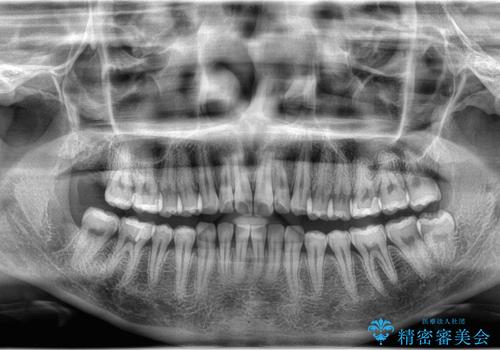 親知らず抜歯の治療前