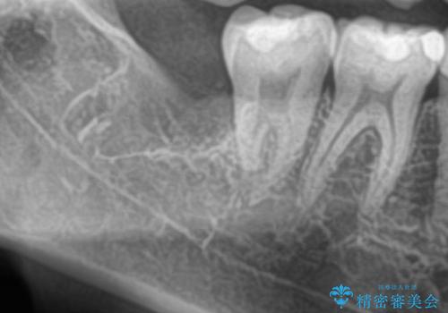 親知らずを抜きたい 親知らず抜歯の治療後