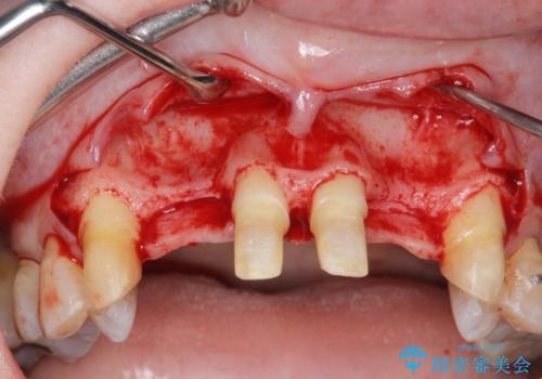[ 全て歯を抜かなければいけないと言われた] 矯正治療を含む包括的歯周病治療の治療前