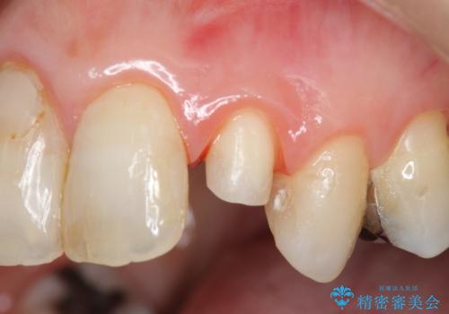 [ ジルコニアセラミッククラウン] 神経の死んだ前歯の治療の治療中
