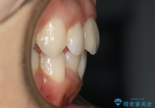 出っ歯が気になる 抜歯+ワイヤー矯正治療の治療後
