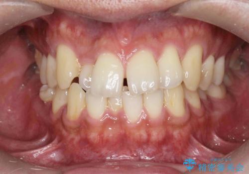 [ インビザライン矯正 ]  マウスピースで治す、すきっ歯　がたつきの治療前