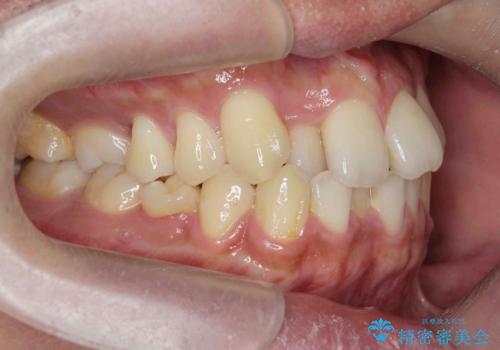 [ インビザライン矯正 ]  マウスピースで治す、すきっ歯　がたつきの治療前