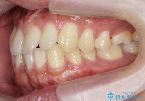 [ インビザライン矯正 ]  マウスピースで治す、すきっ歯　がたつきの治療前